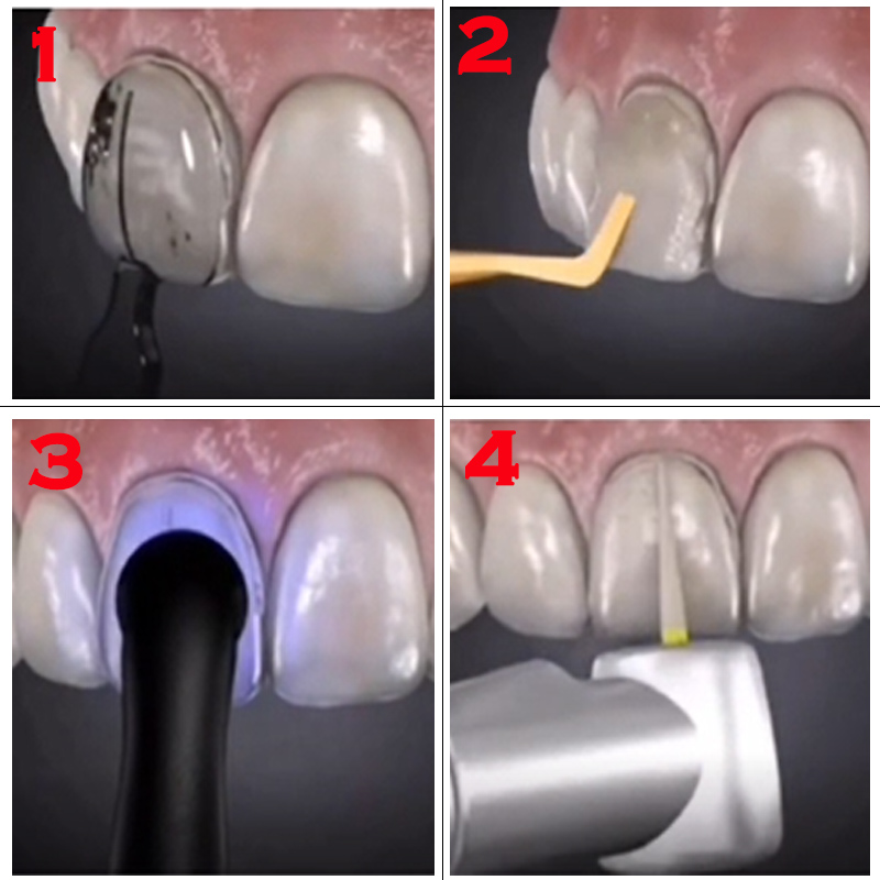 ชุดอุปกรณ์ห้องปฏิบัติการทันตกร - Teeth Whitening Moulds บทวิจารณ์และราคา